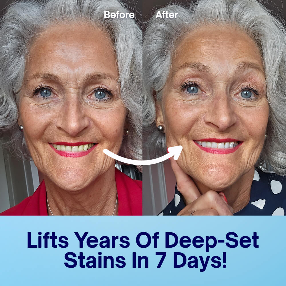 PAP Teeth Whitening Strips